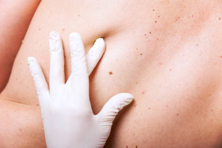 A más bronceados en la niñez, mayor probabilidad de melanoma
